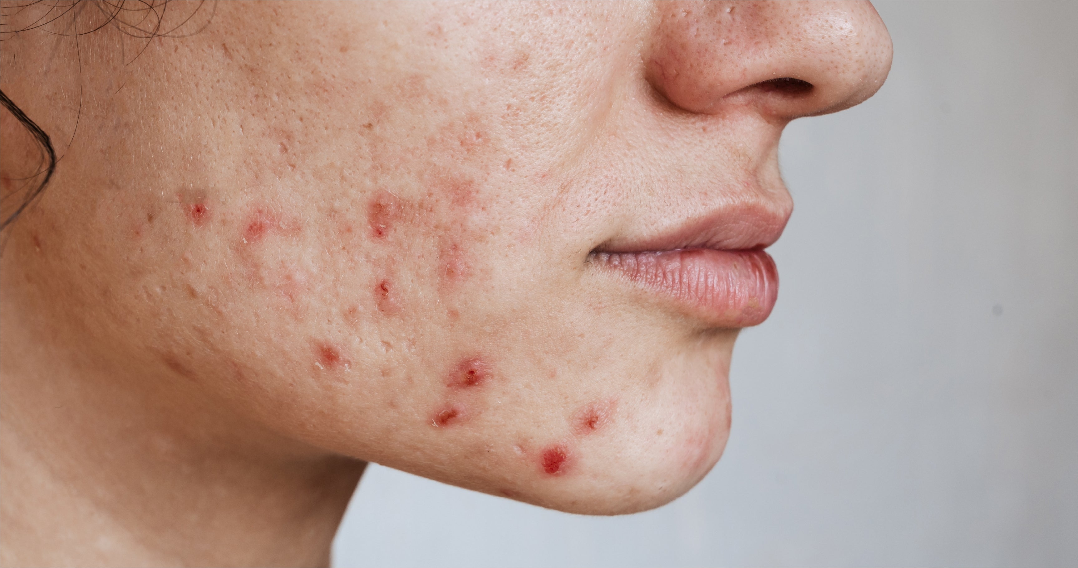 Acne Awareness, Who, What, Why and What Else