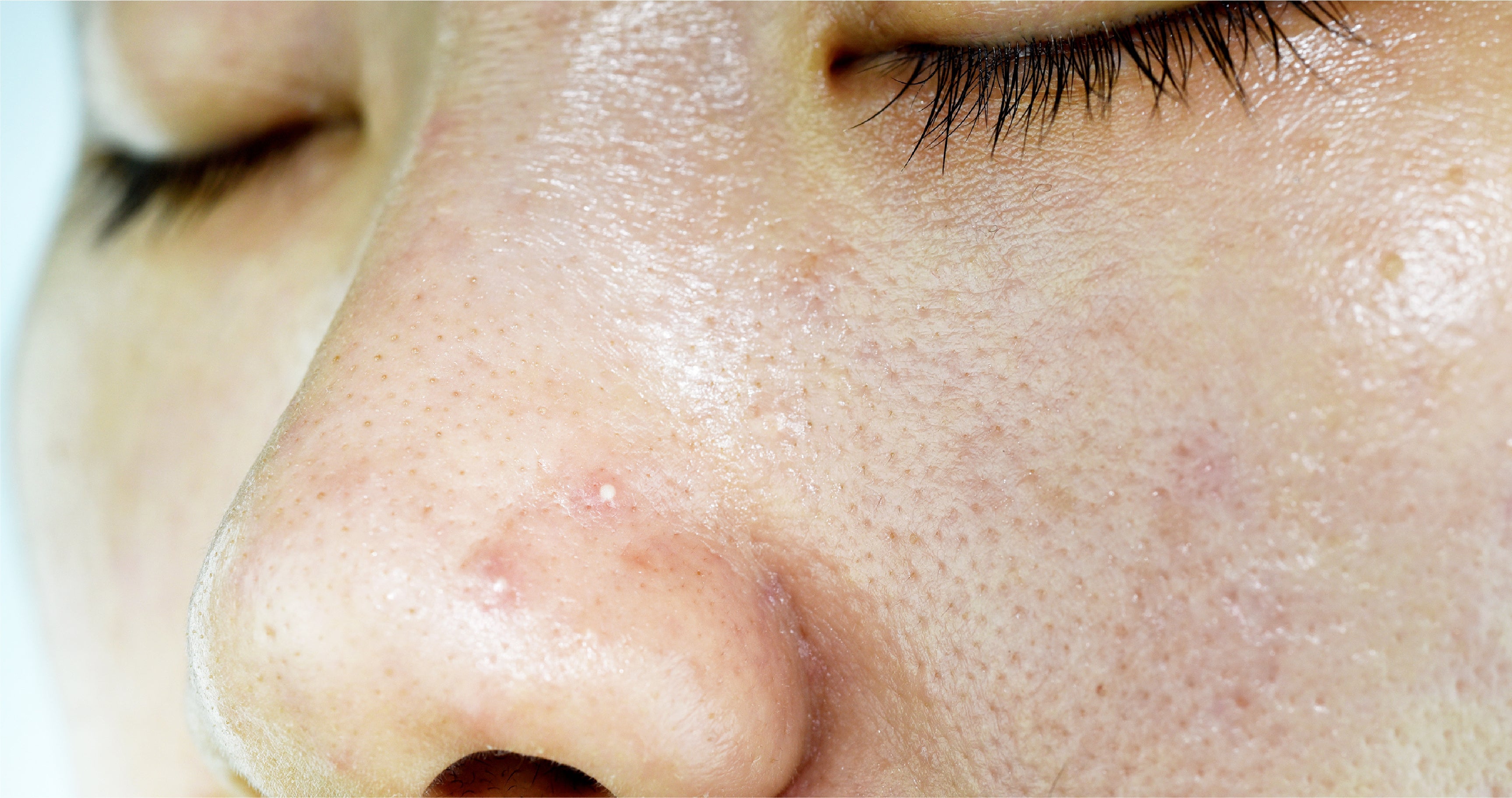 5 Tips for Managing Oily Skin