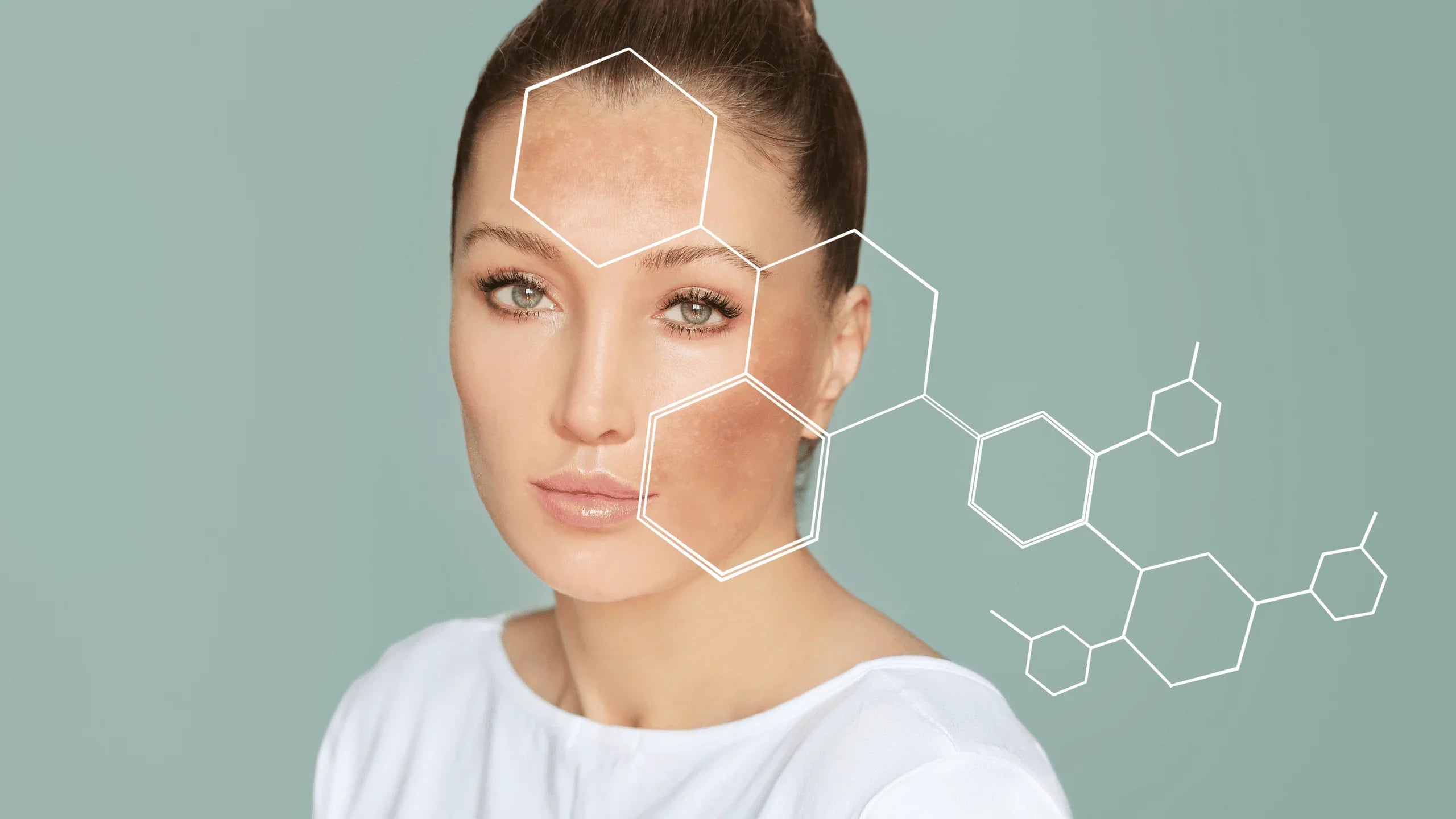 Hyperpigmentation and Melasma: What are they?